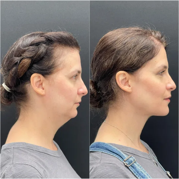Jaw Surgery Consultation